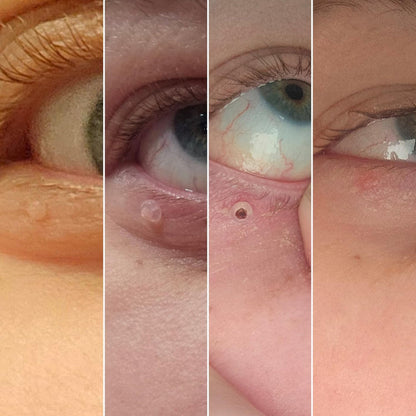 Meu Tag - Kit para remoção de verrugas na pele