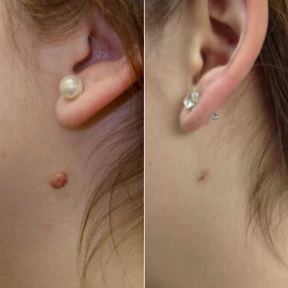 Meu Tag - Kit para remoção de verrugas na pele